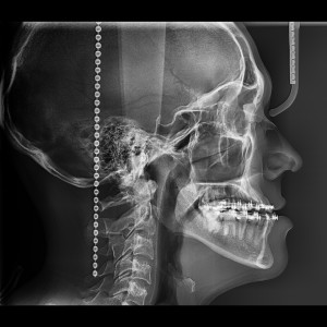 CEFALOMETRIA FULL LATERAL