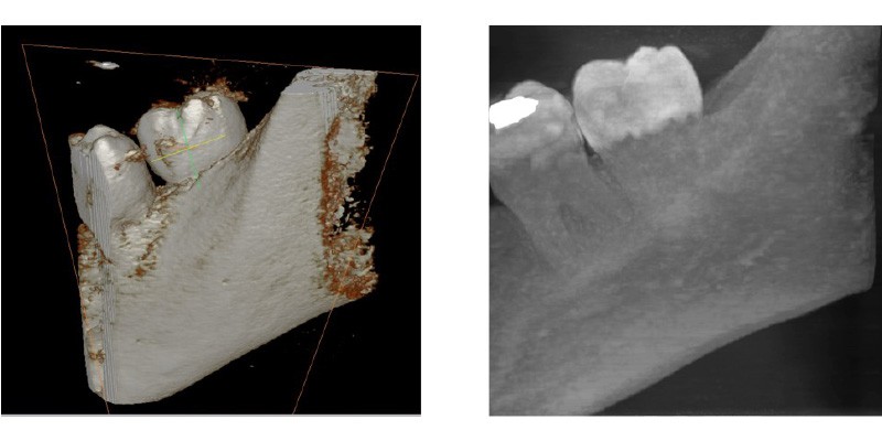 FOV 5X5 PERIAPICAL