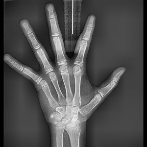 CARPAL