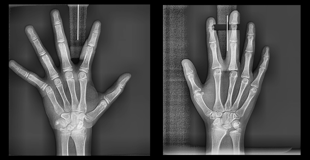 CARPAL