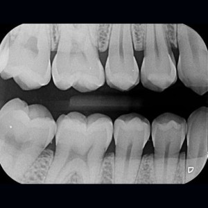 INTERPROXIMAL