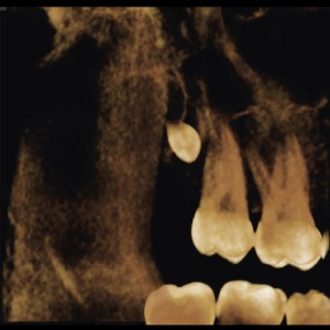 FOV 5X5 PERIAPICAL