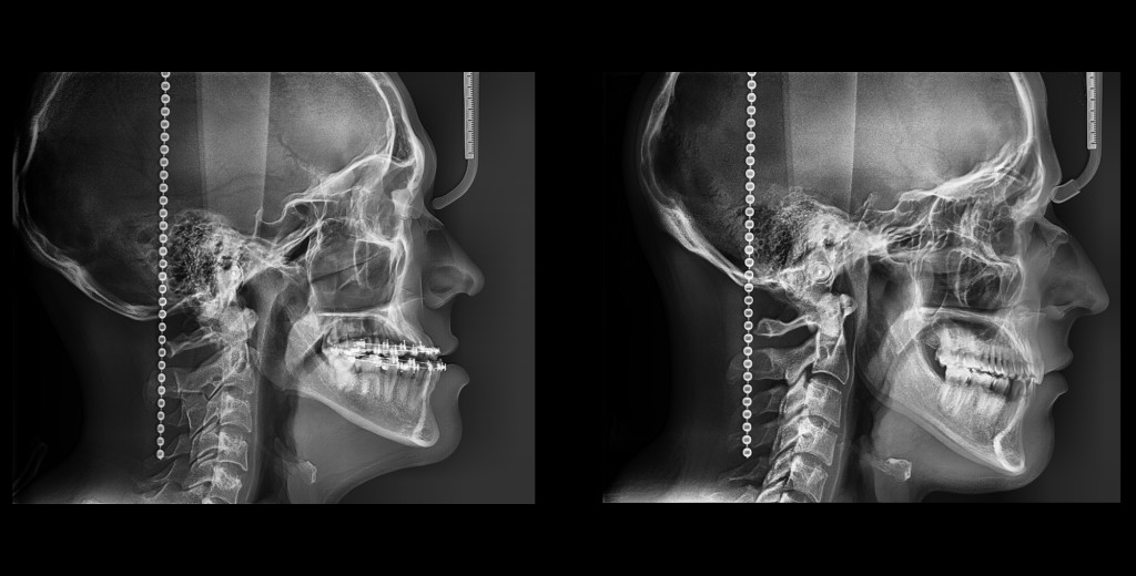 CEFALOMETRIA FULL LATERAL